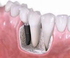 Dental Implants for Replacing Missing Teeth by Smile Stylers