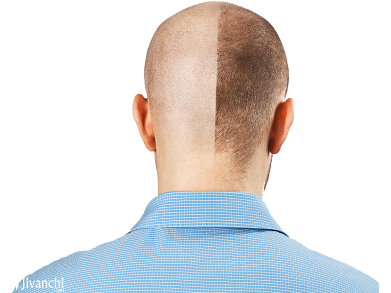 Top Hair Transplant Clinic in Hyderabad | Hair Clinic in Hyderabad - 2