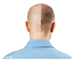 Top Hair Transplant Clinic in Hyderabad | Hair Clinic in Hyderabad - Image 2