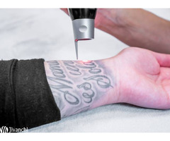 Best Tattoo Removal Clinic in Hyderabad | Best Dermatologist in Hyderabad - Image 1