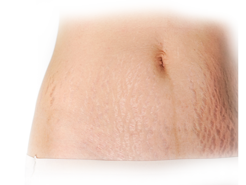 Stretch Mark Removal Clinic in Hyderabad | Stretch Marks Treatment - 2