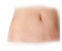 Stretch Mark Removal Clinic in Hyderabad | Stretch Marks Treatment - Image 2