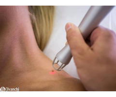Invasive Treatment for Skin Tag Removal in Hyderabad - Pelle Skin & Hair Clinics - Image 1