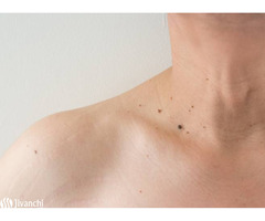 Invasive Treatment for Skin Tag Removal in Hyderabad - Pelle Skin & Hair Clinics - Image 2