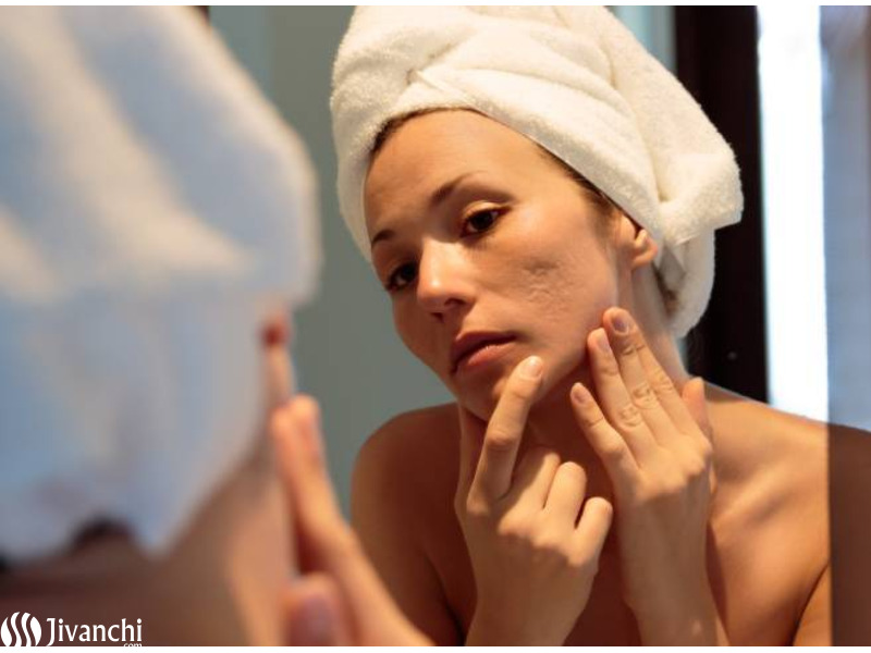 ACNE Treatment and Scar Removal Treatment in Hyderabad - Pelle Clinic - 2