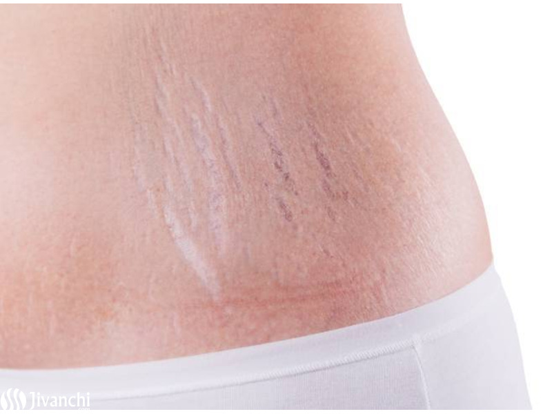 Stretch Mark Removal Clinic in Hyderabad | Stretch Marks Treatment - 1