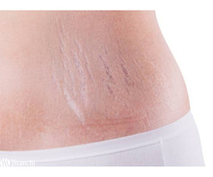 Stretch Mark Removal Clinic in Hyderabad | Stretch Marks Treatment - Image 1