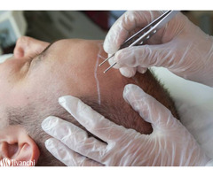 Top Hair Transplant Clinic in Hyderabad | Hair Clinic in Hyderabad - Image 1