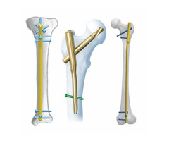 CE Certified Orthopaedic Implants