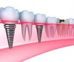 Multi Speciality Dental clinic and Dental Implant centre Kerala