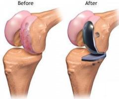 Partial Knee Replacement For Arthritis Patients - Image 1