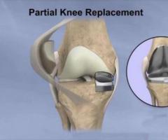 Partial Knee Replacement For Arthritis Patients - Image 2