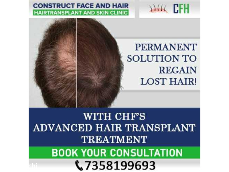 Best Hair Transplant in Chennai - 1