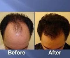 Hair Transplant - Image 1