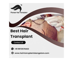 Best Hair Loss Treatment in Bangalore by Pioneer