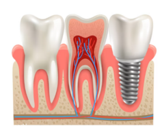Best Dental Implnat in Mumbai at Smile Again Dental Clinic