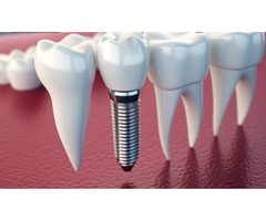 Best Dental Implnat in Mumbai at Smile Again Dental Clinic - Image 3