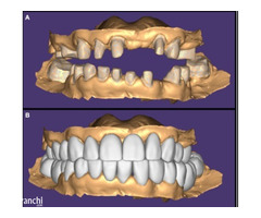 Best Dentist in Wadala East & West for Full Mouth Rehabilitation at Smile Again Dental Clinic