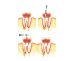 Best Dentist in Mahim East for Root Canal at Smile Again Dental Clinic - Image 2