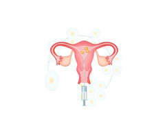 IUI Treatment In Delhi NCR
