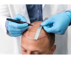 Hair Transplant In Delhi NCR