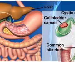 Affordable Gall Bladder Cancer Treatment In Kochi