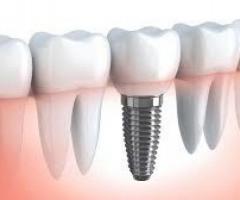 Dental bridges are used to create one or more missing teeth.