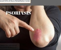 PSORIASIS Center For Advanced Ayurveda And Research