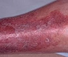Effective Ayurvedic Treatment For Eczema In Cochin