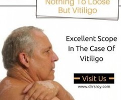 Opt Ayurveda Vitiligo Treatment​, Results Are Evident