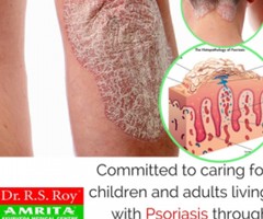 Get Rid Of Psoriasis Forever With The Help Of Ayurveda