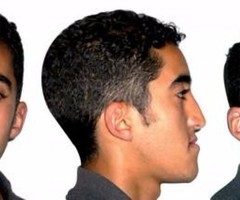Reshape Your Crooked Jaw with Jaw Deformity Treatment