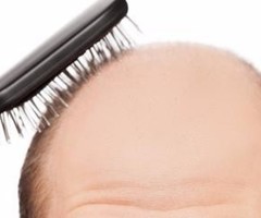 Regain Your Youth And Confidence By Hair Transplantation