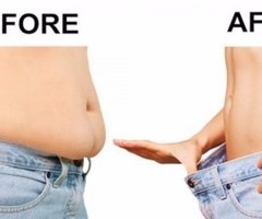 Find Your Curves With Liposuction In Trivandrum