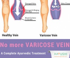 Be Free From Varicose Veins With Ayurveda