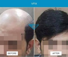 Platelet Rich Plasma For Hair Loss