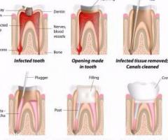 Root Canal Treatment