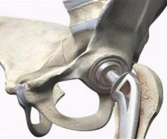 Best Hip Replacement Treatment In Kochi