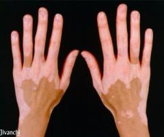 Choose Ayurvedic Treatment for Vitiligo or Skin White Paches - Image 1