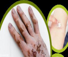 Choose Ayurvedic Treatment for Vitiligo or Skin White Paches - Image 2