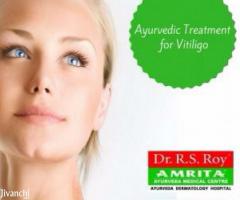 Highly Effective Ayurvedic Treatment for Vitiligo