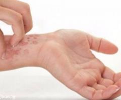Psoriasis Ayurvedic Treatment – For Scar Free Skin - Image 1