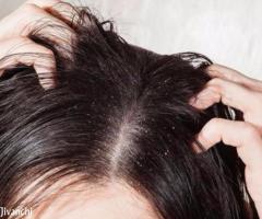 Get A Complete Solution To Dandruff With Ayurveda - Image 3