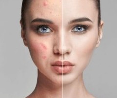 Acne Treatment Treatment Clinic|DermaLife-Dr.Gaurav Garg