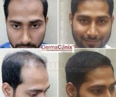 Hair Transplant Doctor in Chennai - DermaClinix