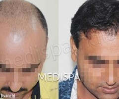 Know about Hair Transplant Cost in Bangalore for best treatment